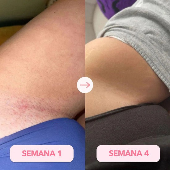Depiladora Laser IPL™ | Elimina crecimiento del vello