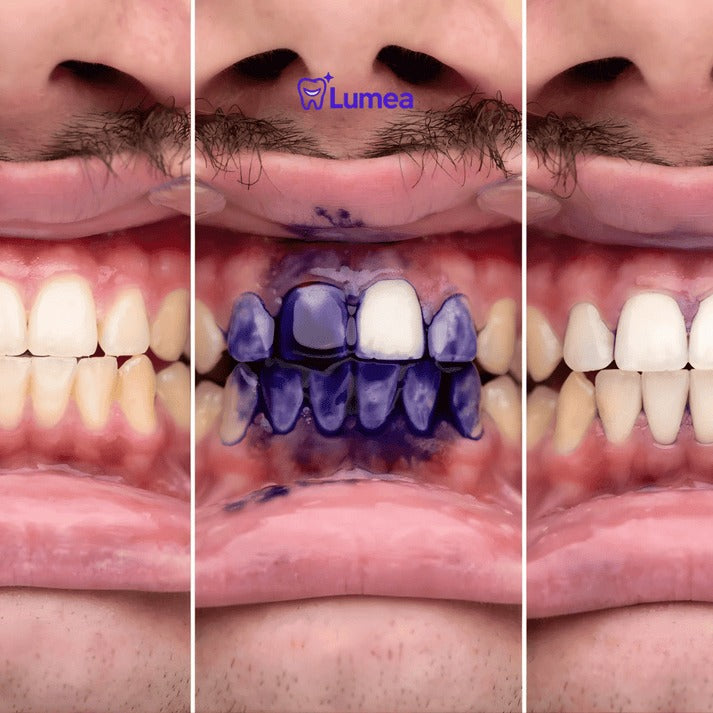 Lumea™ | La crema blanqueadora Nº1